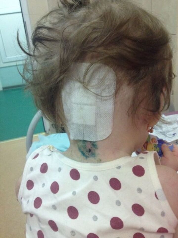 Операция по установке титановой конструкции VERTEX Мазуквой Инне — фото 1